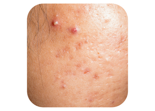 Active Acne + Cysts